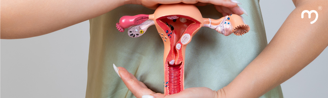 imagen que representa el cáncer de cuello uterino