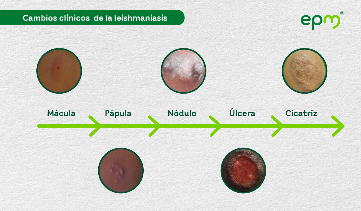 Diagrama 2: Cambios clínicos de la leishmaniasis